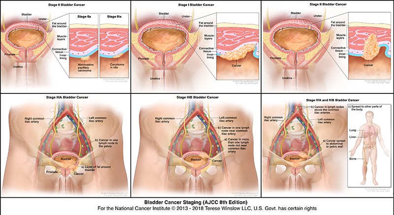 Bladder Cancer Texas Urology Specialists